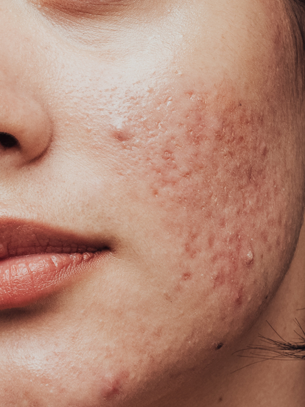 Acne Scars