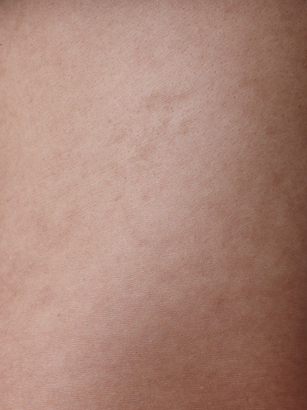 Dull Skin + Collagen Loss